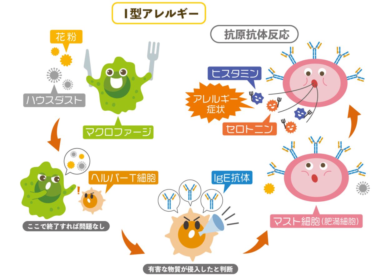 Ⅰ型アレルギー