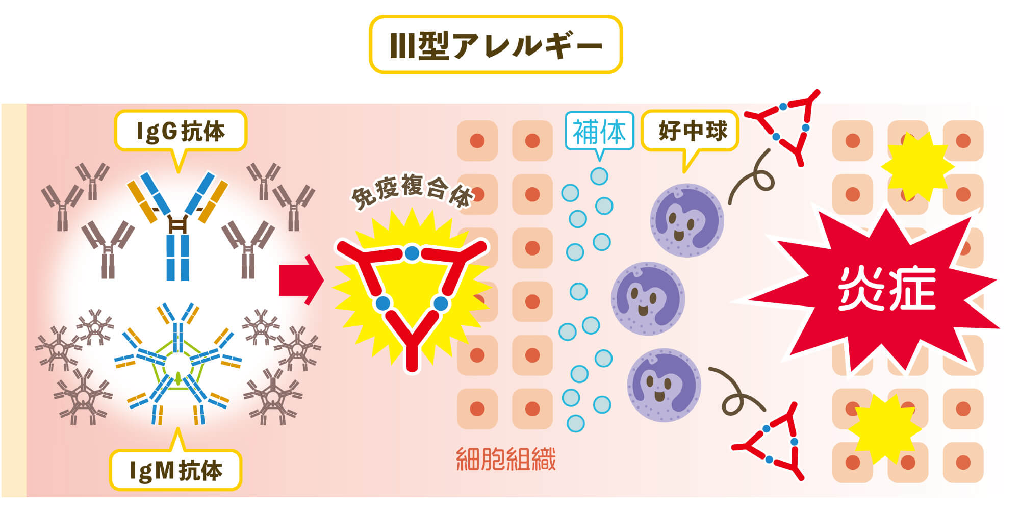 Ⅲ型アレルギー