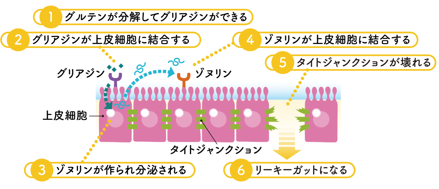 リーキーガット症候群の原因