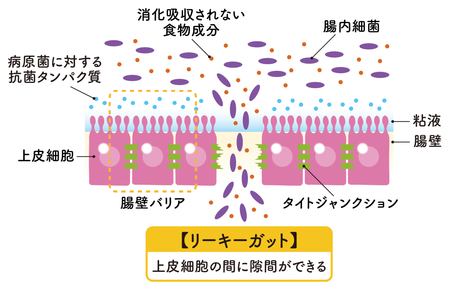 リーキーガット症候群とはを説明した画像